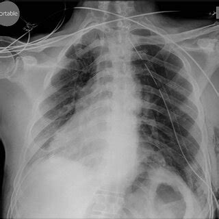 Chest X-ray performed preoperatively. | Download Scientific Diagram