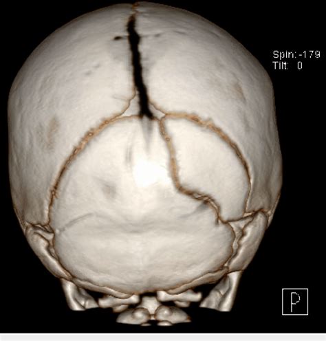 Figure 3 From Imaging Findings In Pediatric Accessory Cranial Sutures