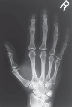 Hand And Wrist Imaging Flashcards Quizlet