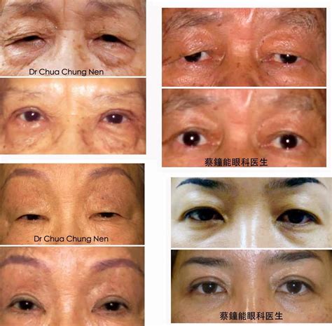 Dermatochalasis Or Excess Skin Of Upper Eyelids Eye Specialist Centre Kuching Sarawak Malaysia