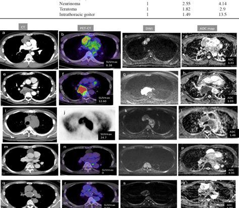 Chest Ct A Pet Ct B Dwi C And Adc Map D Of A Patient With