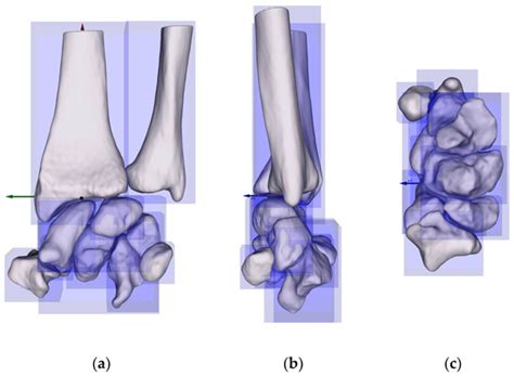 Sex Specific Size Analysis Of Carpal Bones Implications For Orthopedic