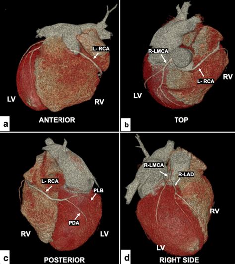 Ct Coronary Angiography Volume Rendering Technique Images Showing The