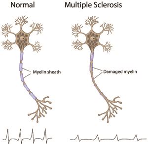 Part I: Understanding Progression in MS | MSAA