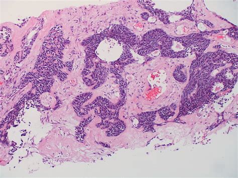 Basaloid Squamous Cell Carcinoma Case 247 Atlas Of Pulmonary