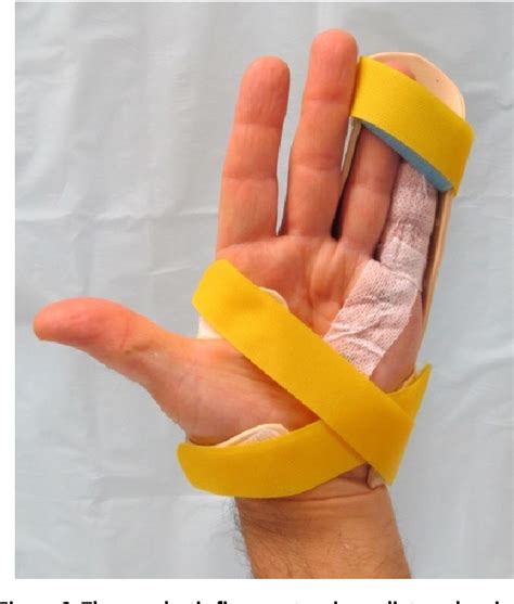 Finger Splint For Dupuytrens Contracture Wide Varieties Boysvelvetjp