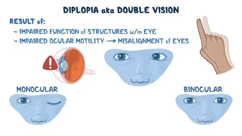 Approach To Diplopia Clinical Sciences Osmosis Video Library