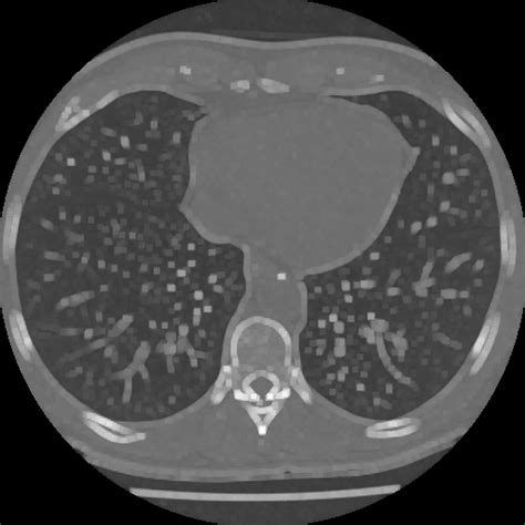 Dilat Lung Instance Segmentation Dataset By Tests