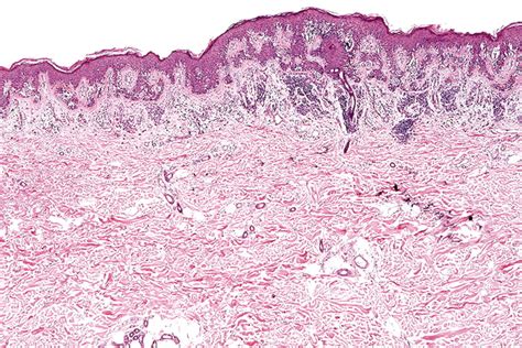 My Approach To Atypical Melanocytic Lesions Journal Of Clinical Pathology