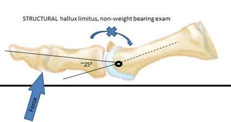 Surgical Correction Of Hallux Limitus Big Toe Joint Arthritis Central Massachusetts Podiatry