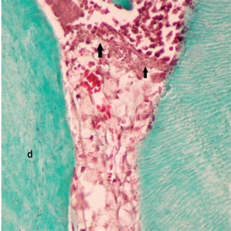 Band Like Structure Separating The Inflammatory Infiltrate Adjacent To