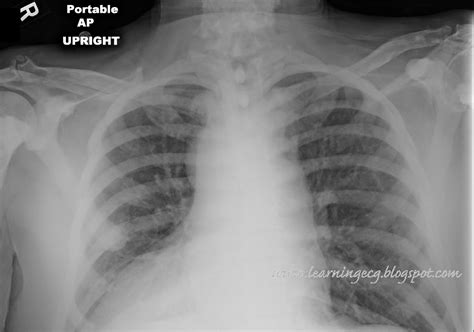 Ecg Rhythms Ectopic Atrial Rhythm In Dextrocardia