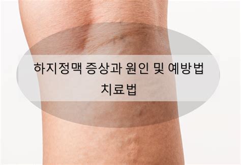 하지정맥 증상과 원인 및 예방법 치료법 호율안 소소한 이야기