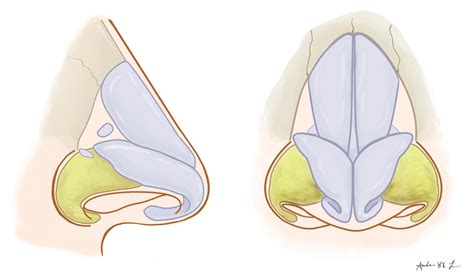 Tip Rhinoplasty Alar Structural Support Techniques Rhinoplasty Archive