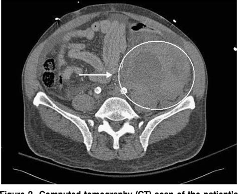 Figure 2 From Spontaneous Retroperitoneal Hemorrhage In A Dialysis