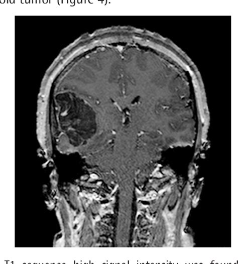 Figure 1 From Three Rare Localizations Of Intracranial Dermoid Tumors