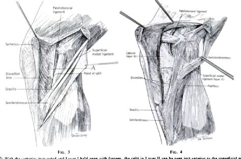 The Supporting Structures And Layers On The Medial Side Of The Knee An