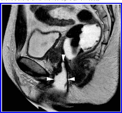 Figure 1 From Mr Imaging In Patients With Male To Female Sex