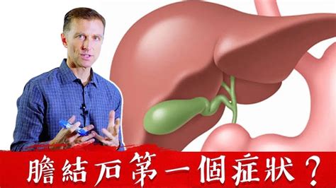 膽結石的第一症狀？80膽結石的人自然療法柏格醫生 Dr Berg Youtube