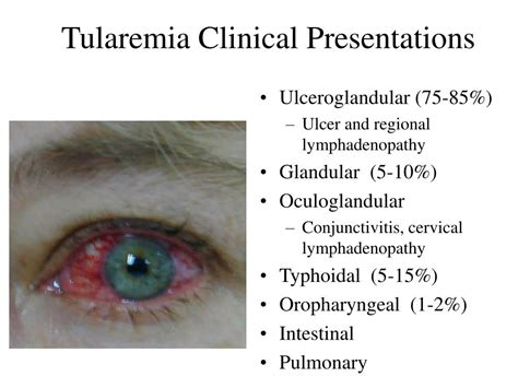 Ppt Plague And Tularemia Powerpoint Presentation Free Download Id