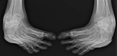 Clubfoot Deformity Measurements X Ray