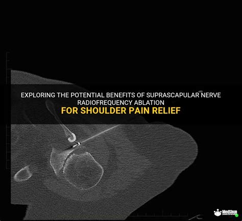 Exploring The Potential Benefits Of Suprascapular Nerve Radiofrequency Ablation For Shoulder