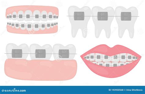 Orthodontic Set Of Jaws With Teeth With Braces Vector Illustration