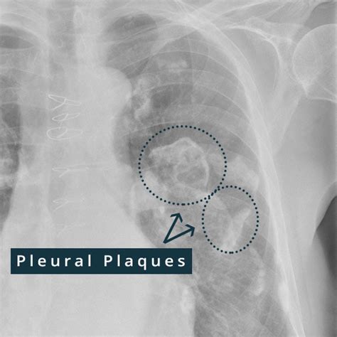 Pleural Plaques - Causes, Symptoms, Diagnosis, Treatment