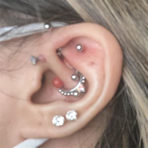 Bumps On Daith Help Rpiercingadvice