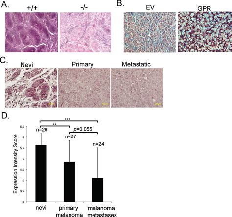 Gpr Regulates Vegf Production And Angiogenesis During Melanoma