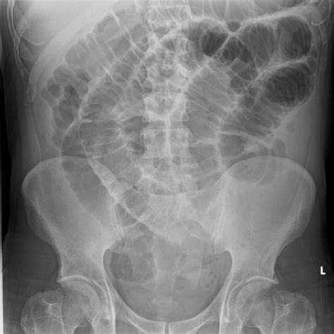 Bowel Obstruction And Mesenteric Ischaemia Flashcards Quizlet