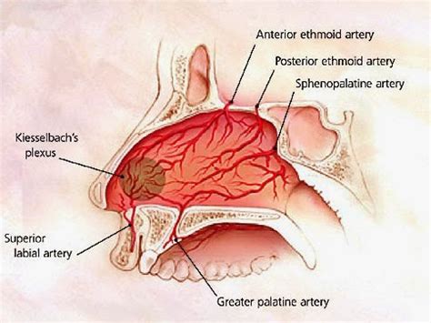 Emergency Medicine: Epistaxis