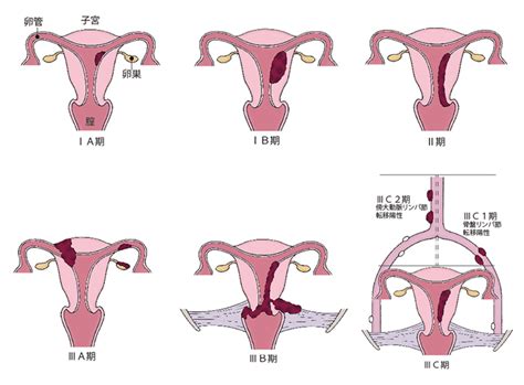 子宮がん｜がんの先進医療｜蕗書房
