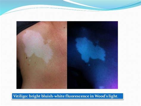 Wood’s light in dermatology