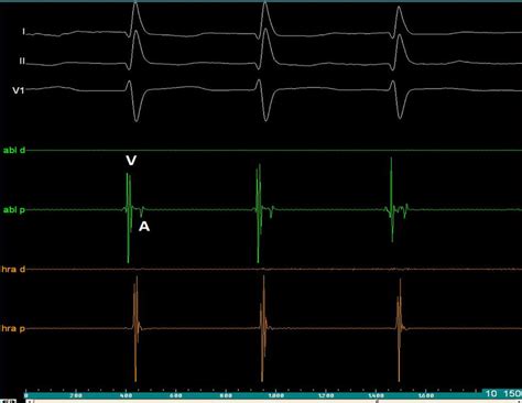 Intracardiac Electrogram Of Junctional Rhythm After Radiofrequency