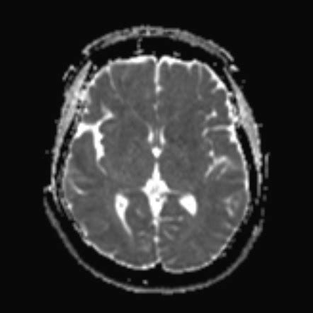 Jugular Foramen Schwannoma With Cystic Degeneration Image