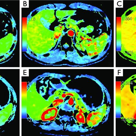 Representative Pancreas Images From The Continuous Perfusion Scan A C