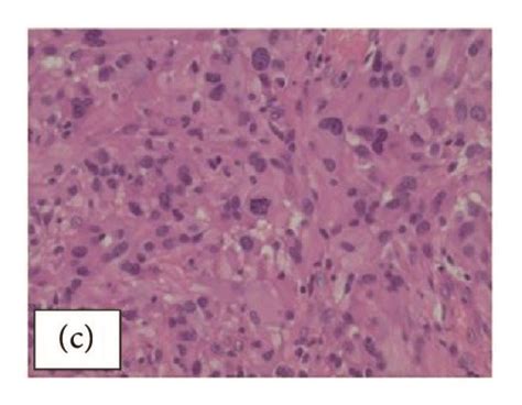 A Histologic Sections Showing A Cellular Proliferation Of Pleomorphic