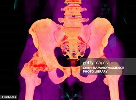 154 Hip Arthritis X Ray Stock Photos, High-Res Pictures, and Images ...