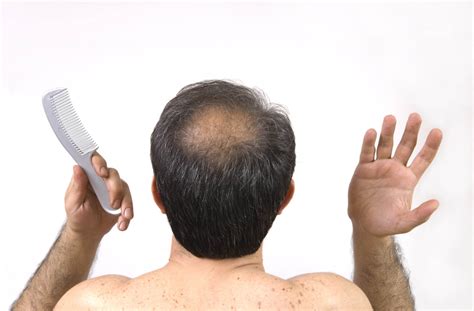 Comment Soigner La Perte De Cheveux Chez L Homme Et Traiter La Calvitie