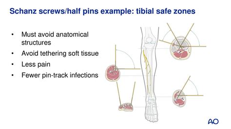 Principles of external fixation - ppt download