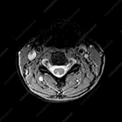 Cervical Spinal Cord with Multiple Sclerosis - Stock Image - M210/0357 ...