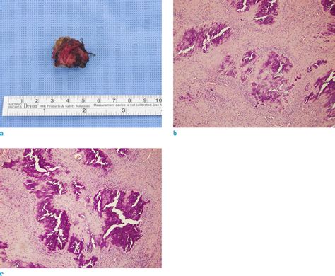 Calcifying Aponeurotic Fibroma Of The Knee A Case Report With