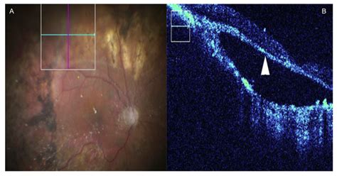 MI-OCT assisted Retinal detachment surgery. (A) En-face view. (B ...