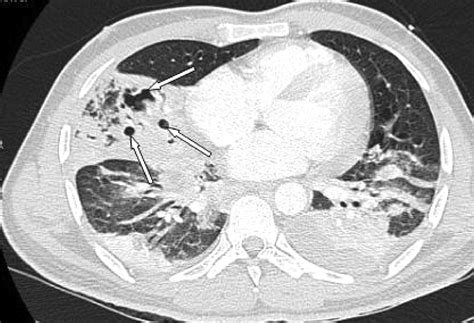 Necrotizing Pneumonia