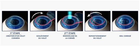 La Révolution Du Laser Femtoseconde Dans La Chirurgie Oculaire