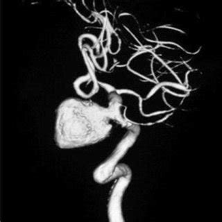 Saccular Aneurysm Arising From Intra Cavernous Segment Of Left Internal