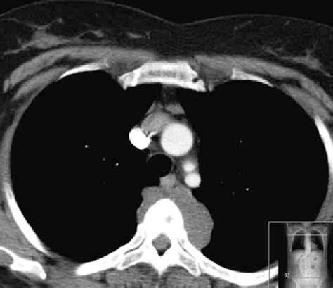 Figure From Chordoma Of A Thoracic Vertebra A Case Report