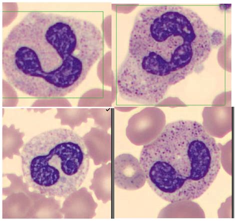 Bandemia What Is It And Why Is It Important Lablogatory