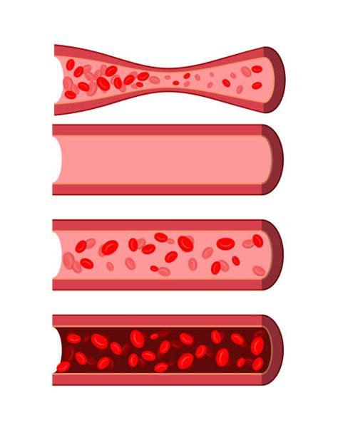 Best Clogged Artery Illustrations Royalty Free Vector Graphics And Clip